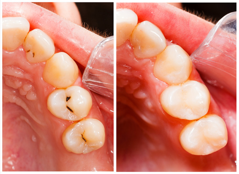 Fillings  Edmonton, AB TJ B