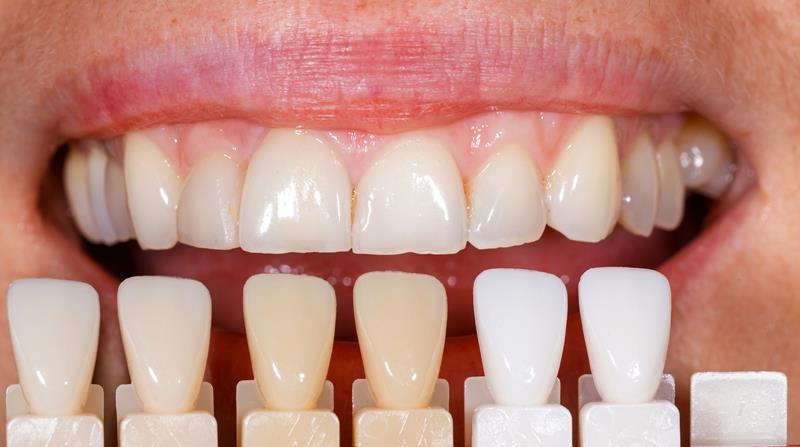 Veneers  Edmonton, AB TJ B
